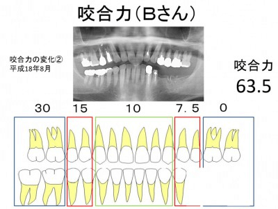 咬合力2