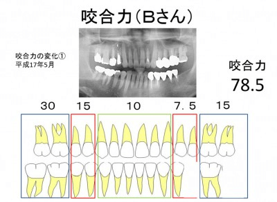 咬合力 草加市の歯医者 いいやま歯科医院