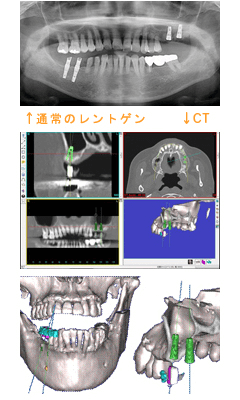 CT検査に関して