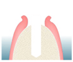 インプラントを埋入