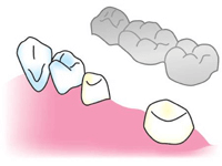 歯を失った場合の治療法