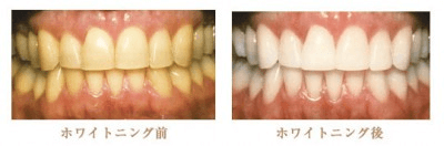ホワイトニング