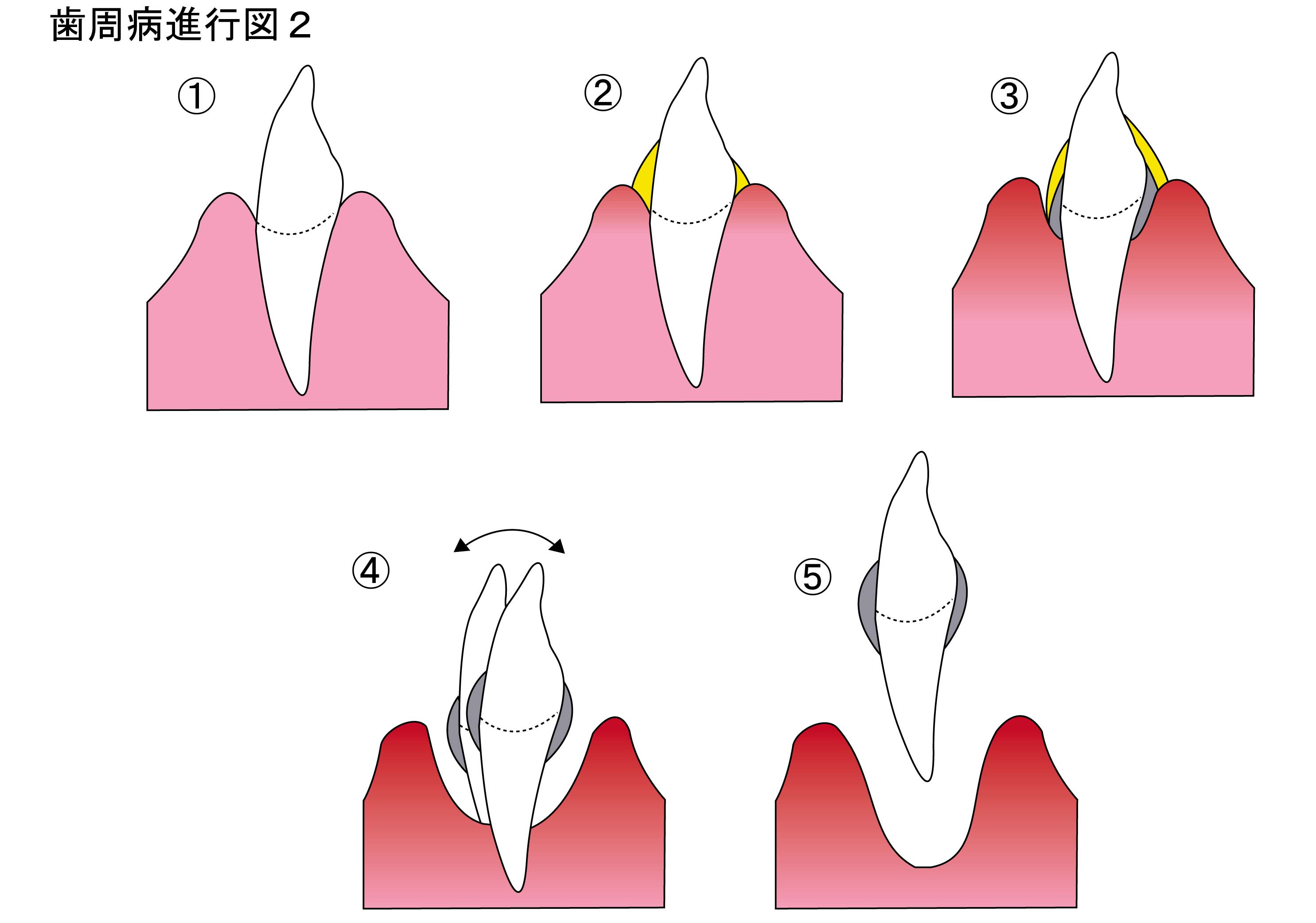 歯と歯肉１３(110500013)