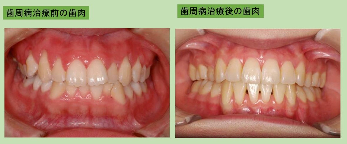 歯周病について_02