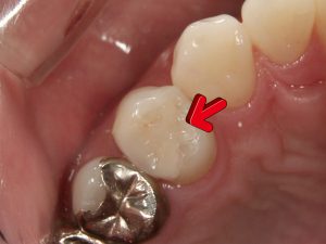 コンポジットレジンインレー臼歯(050103023)