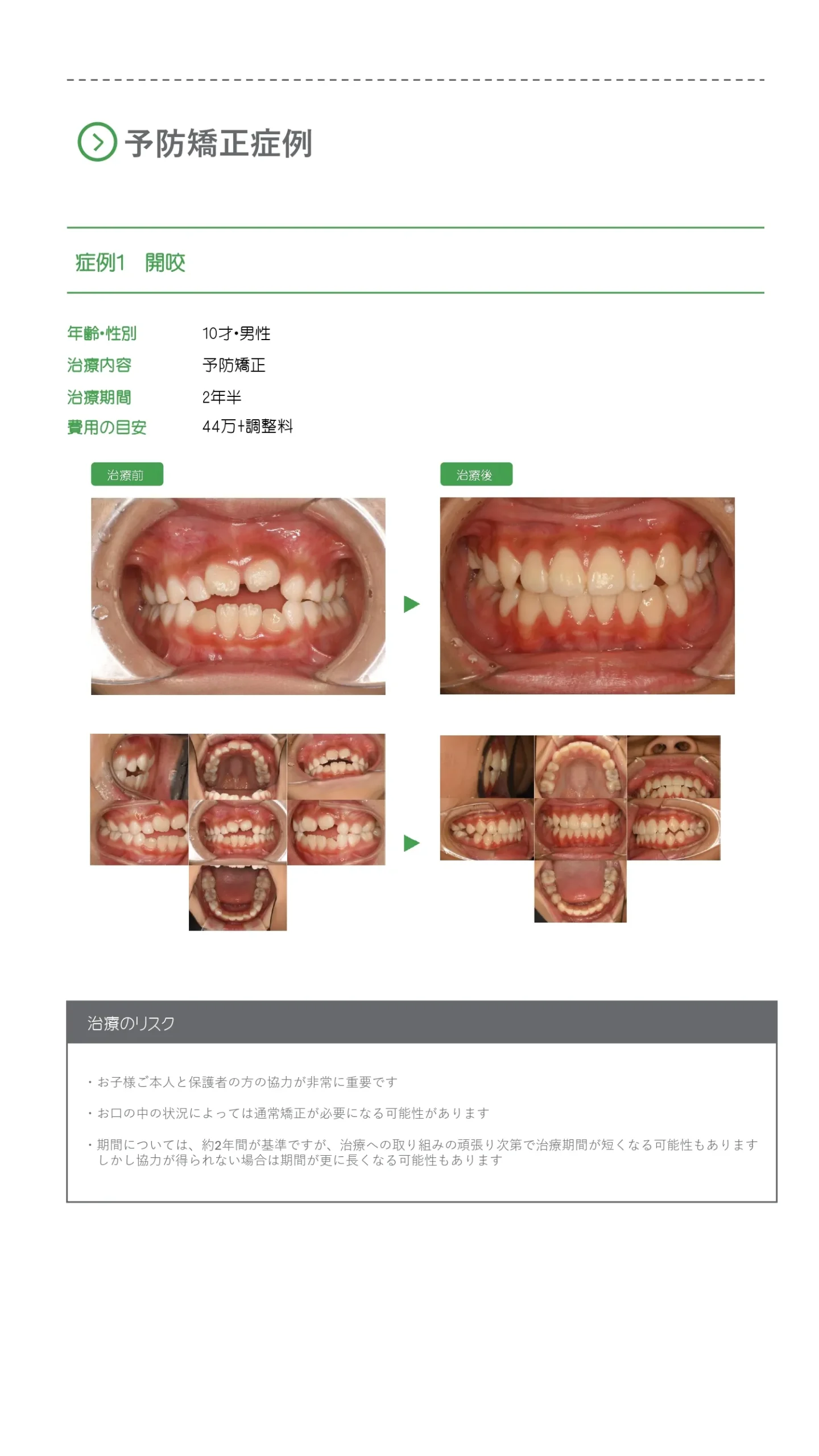 予防歯科症例_1