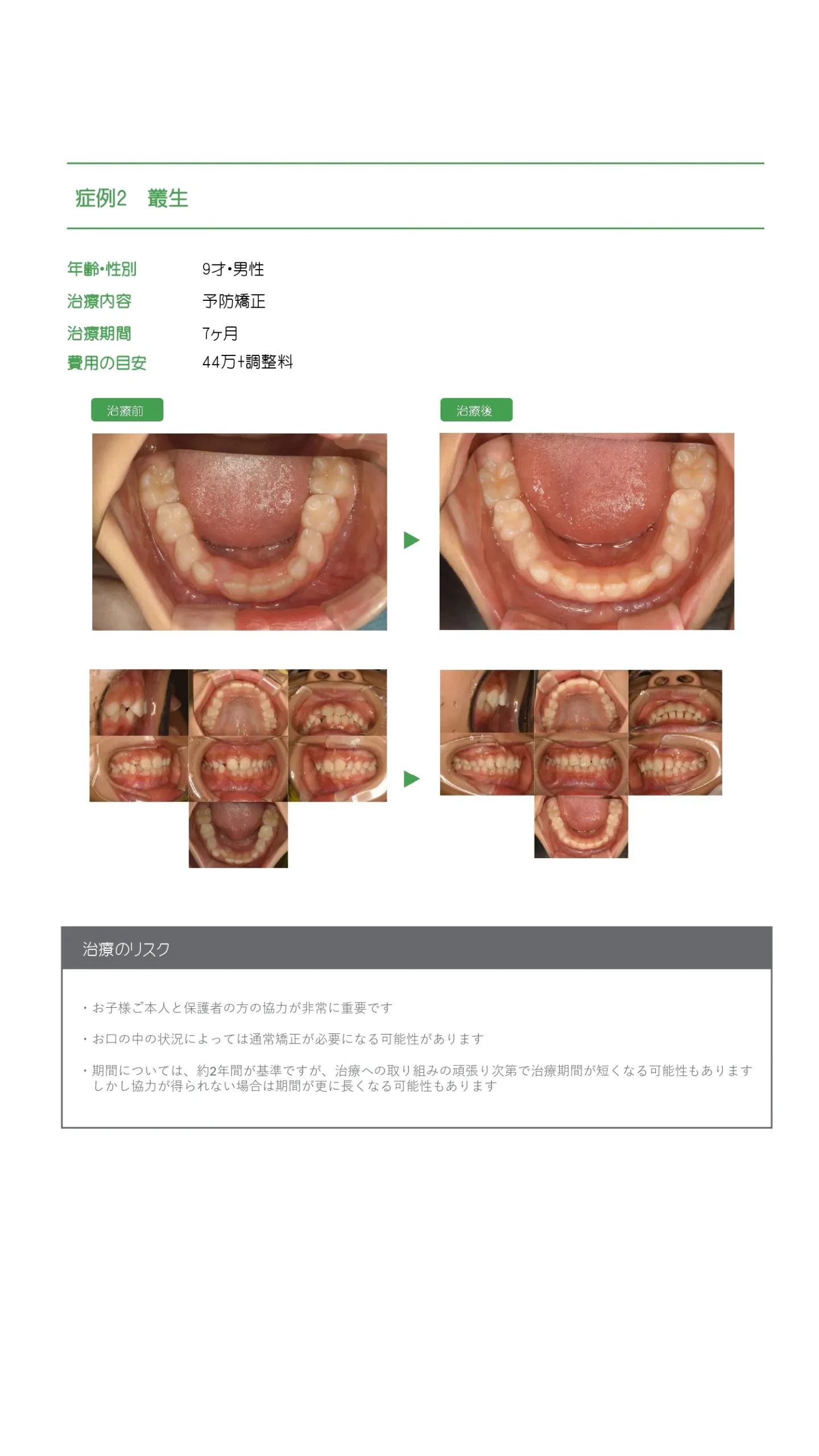 予防歯科症例_1